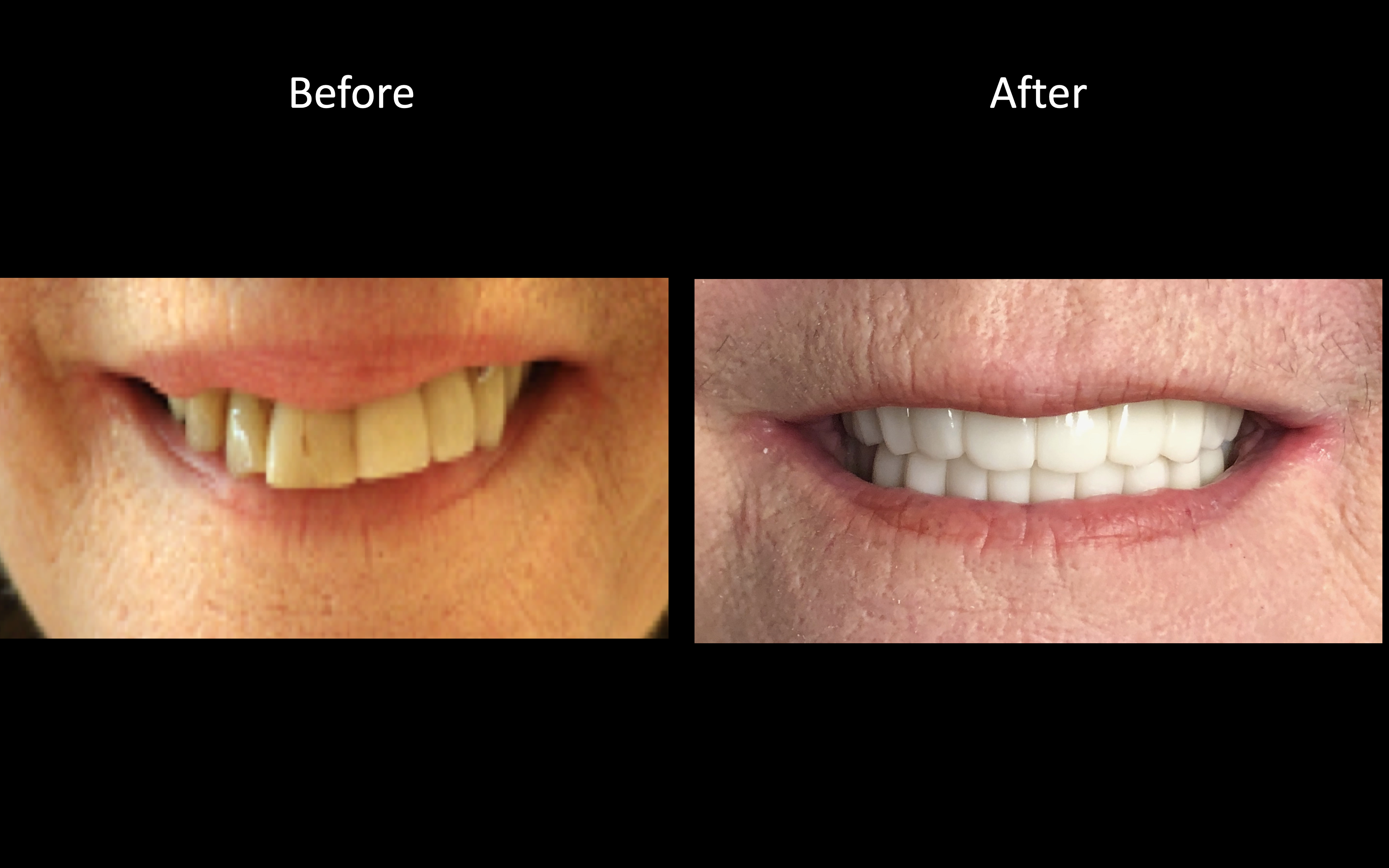 Full Mouth Implant Reconstruction X-Ray Case 3